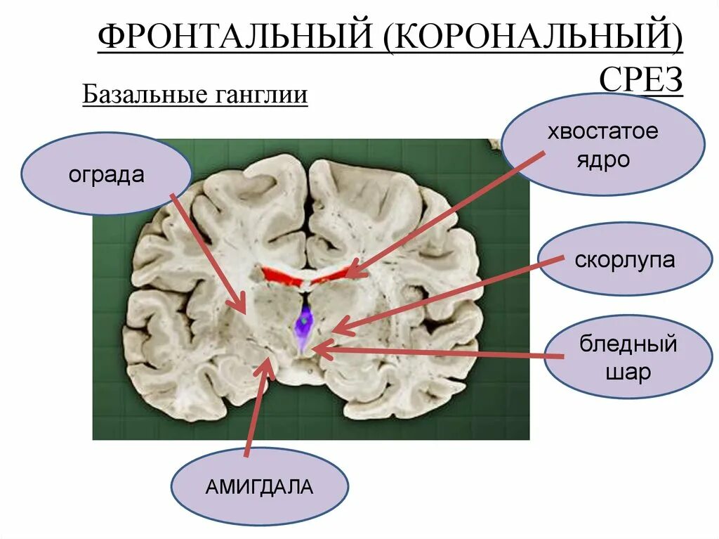 Базальные ганглии головного мозга анатомия. Бледный шар скорлупа хвостатое ядро. Ядра базальных ганглиев. Бледный шар анатомия. Изменение в базальных отделах