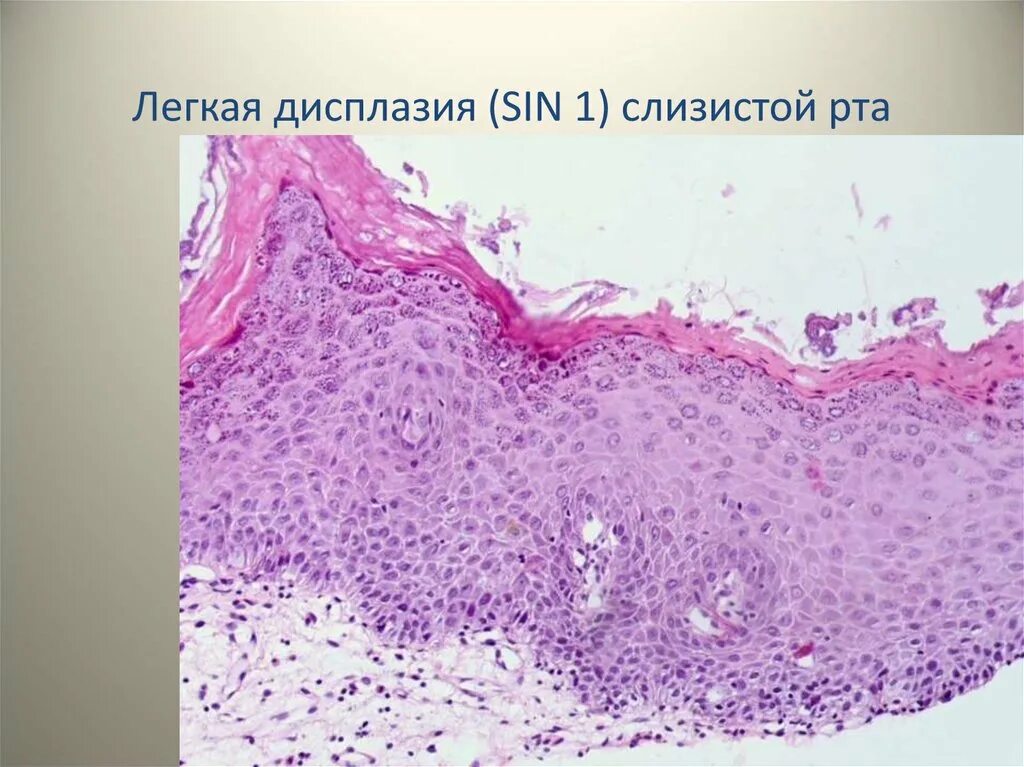 Локализация слизистой оболочки. Дисплазия слизистой рта. Слизистая оболочка рта. Слизистая полости рта гистология.