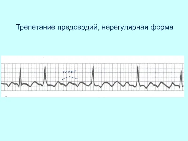 Трепетание 2:1. Трепетание предсердий на ЭКГ. Трепетание предсердий нерегулярная форма. Трепетание предсердий неправильная форма. Формы трепетания предсердий