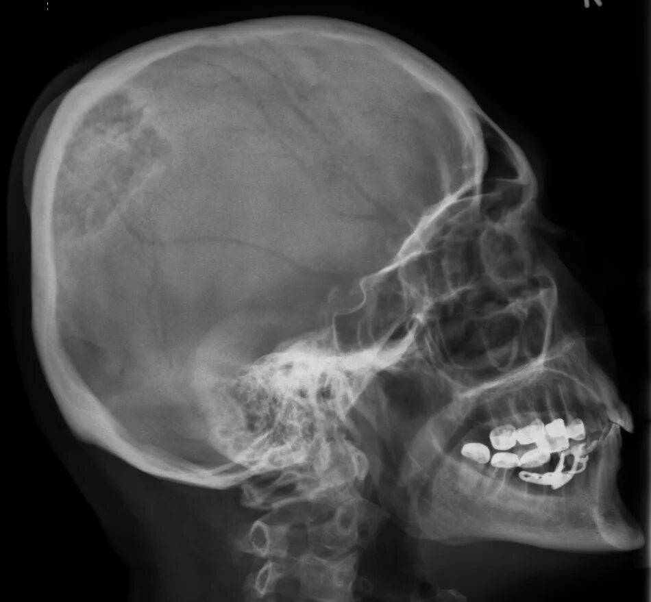 Трещина в голове. Гемангиома костей черепа рентген. Аденома гипофиза рентген черепа. Кости черепа рентген норма. Остеома затылочной кости рентген.