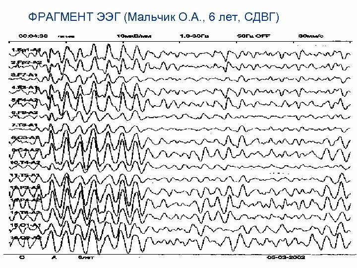 Ээг 6. ЭЭГ при СДВГ. ЭЭГ головного мозга для ребенка СДВГ. Норма ЭЭГ В 7 лет. Норма ЭЭГ В 6 лет.