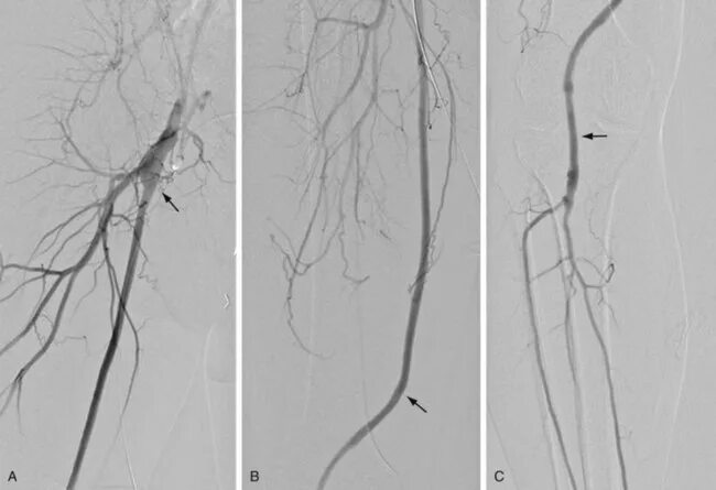 Шунтирование артерий нижних конечностей. Ангиография артерий нижних конечностей. Атеросклероз артерий нижних конечностей ангиография. Стентирование вен нижних конечностей. Ангиография бедренной артерии тромб.