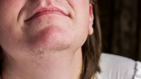 Photos of hirsutism.