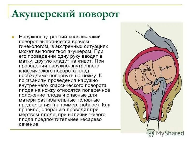 Положение плода акушерское. Акушерский поворот при поперечном положении. Тактика при поперечном положении плода. Неправильное положение плода осложнения. Наружный акушерский поворот при поперечном положении.