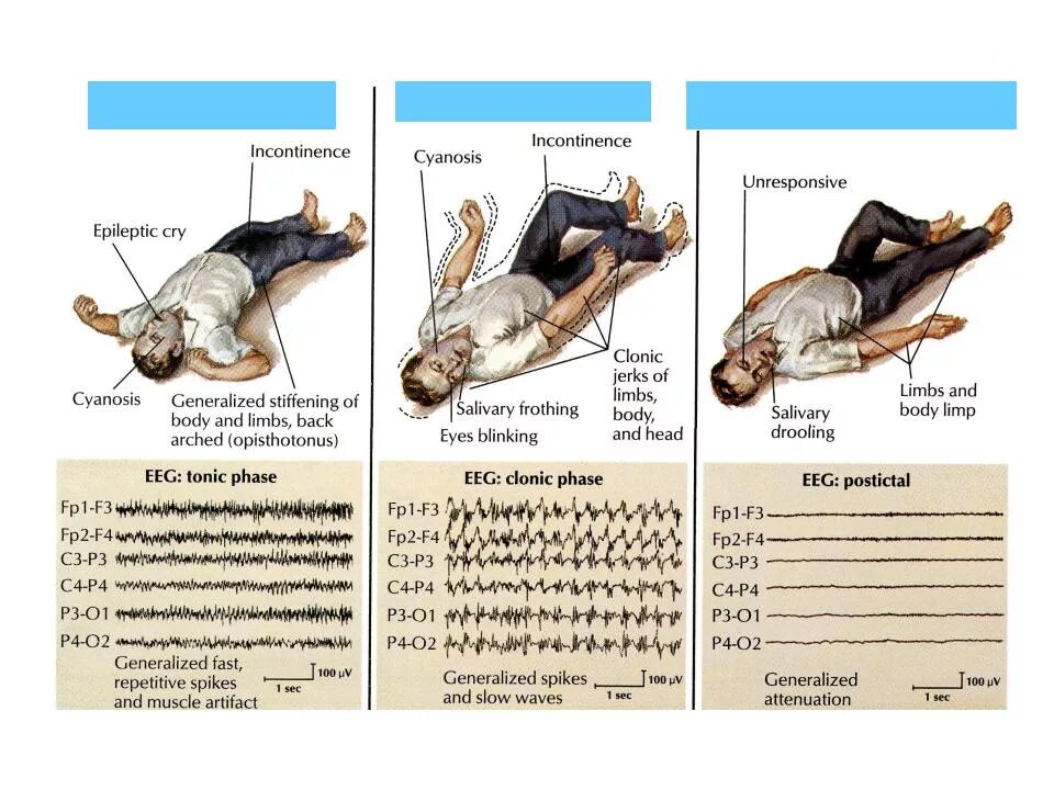 Эпилепсия ночью. "Клоническая фаза генерализованного эпилептического припадка". Эпилепсия судорожный синдром. Фазы генерализованного судорожного припадка при эпилепсии. Клонические судороги при эпилепсии.