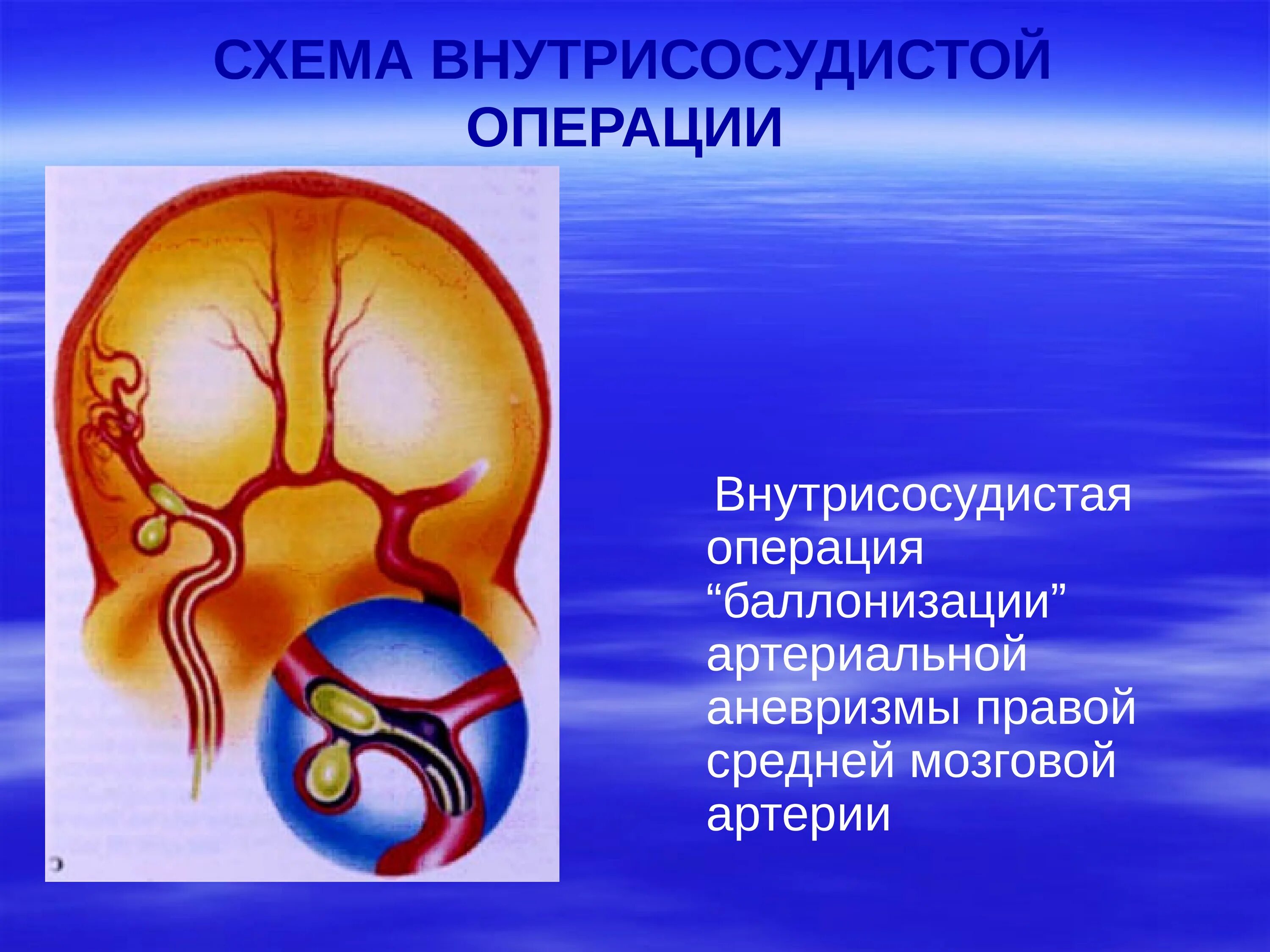 Аневризмы головного мозга презентация. Аневризма правой средней мозговой артерии. Средняя мозговая артерия.