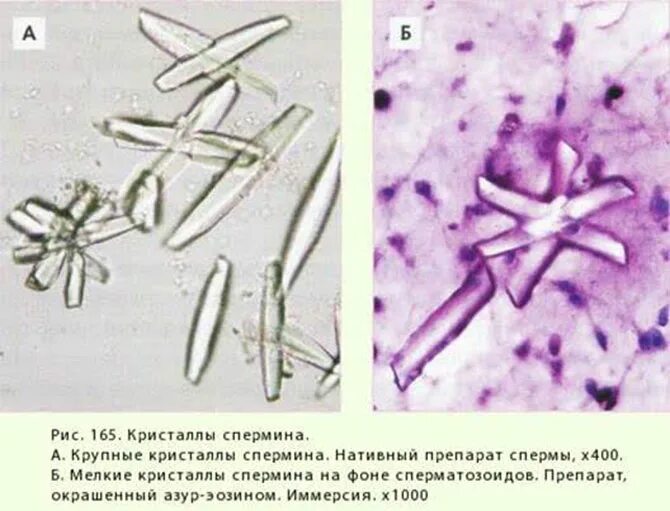 Шарко кале. Кристаллы спермина (беттхера). Кристаллы бетхера микроскопия. Амилоидные тельца микроскопия. Простатический сок микроскопия.