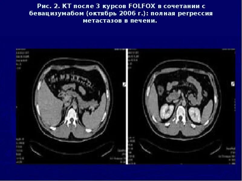 Кт после химиотерапии. Регрессия метастазов в печени. После 3 химиотерапии метастазы. FOLFEX при метастазах в печени.