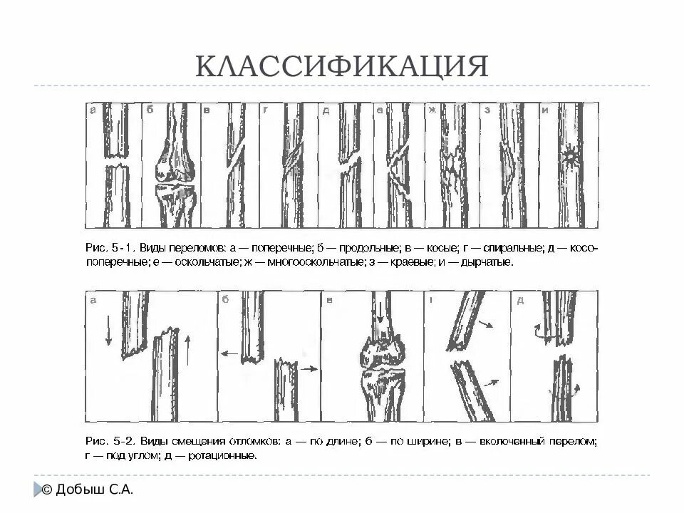 Тип смещения. Классификация переломов по смещению отломков. классификация переломов по направлению и форме. классификация переломов по характеру смещения.