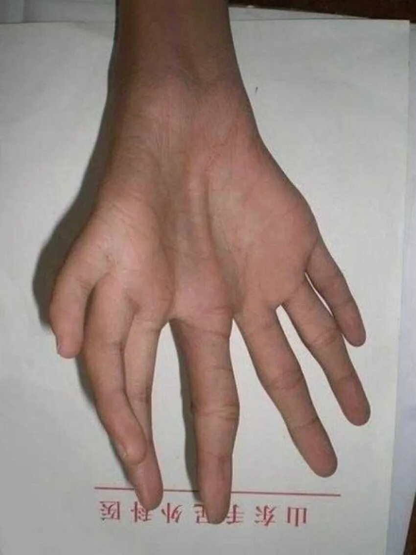 Зеркальные пальцы. Отражение в зеркале. Люди с шестью пальцами на руке. Полидактилия кисти рентген. Полидактилия 8 пальцев.