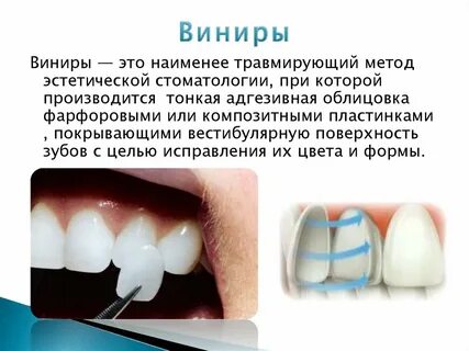 Виниры прямой метод