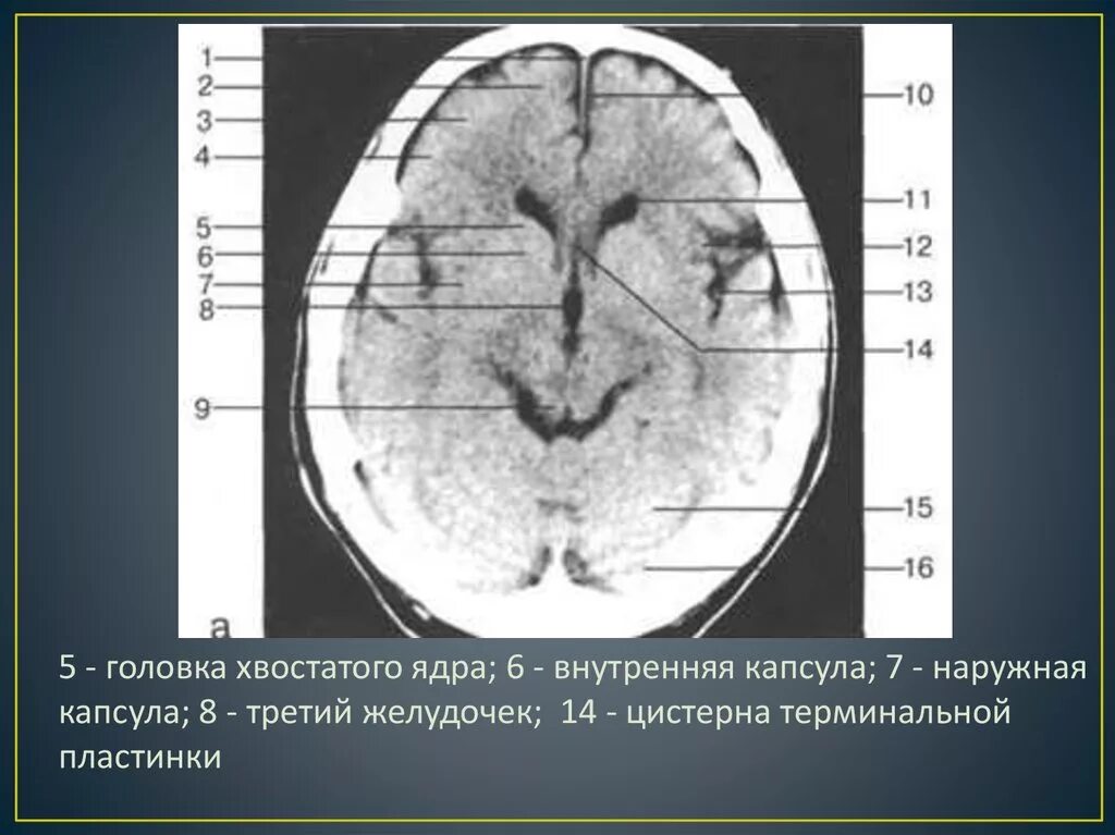 Базальные ядра мрт. Кт анатомия головного мозга аксиальные срезы. базальные ядра головного мозга кт. желудочки мозга анатомия кт. мрт головного мозга фронтальный срез.