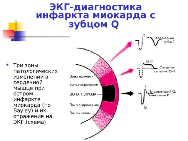 Диагностика ишемии. Зоны инфаркта на ЭКГ. Стадии инфаркта на ЭКГ. Фазы инфаркта на ЭКГ. Инфаркт диагностика ЭКГ.