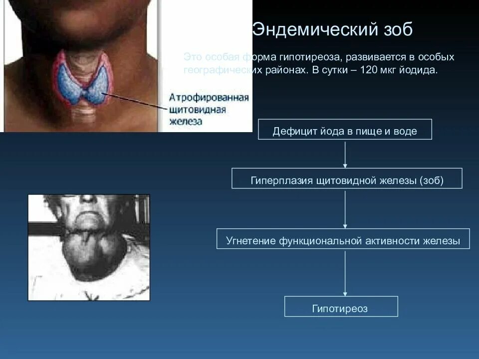 Основной клинический признак эндемического зоба:. Щитовидная железа эндемическая. Болезни эндокринной системы и эндемический зоб. Йоддефицитные заболевания эндемический зоб.