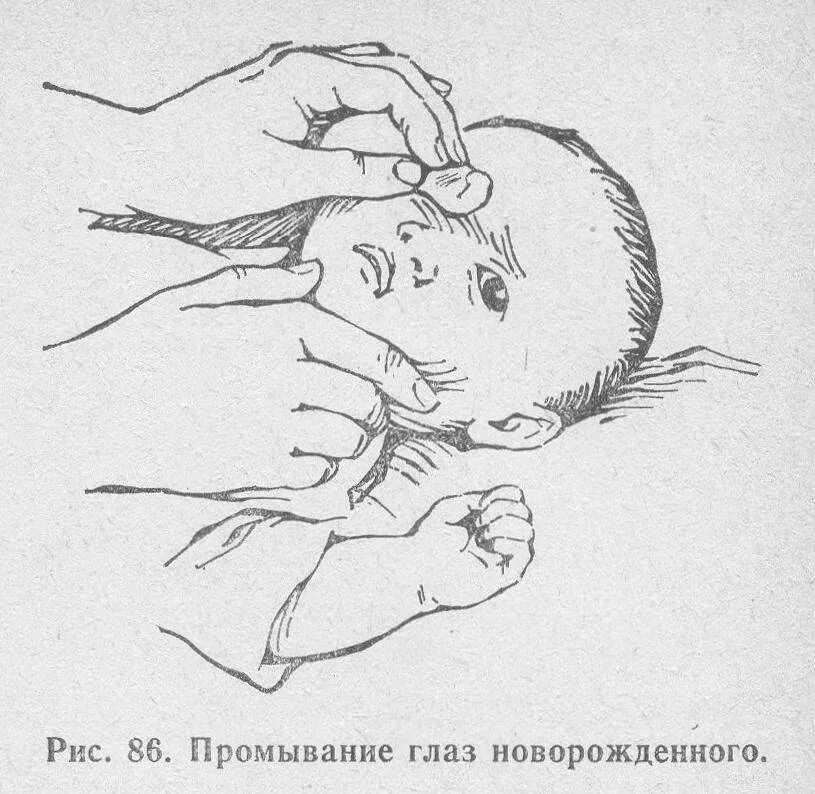 Промывание глаза грудничкам. Чем промывать глазки новорожденному. Протирание глаз новорожденного. Протирание глаз новорожденного. Промывание глаз новорожденному.