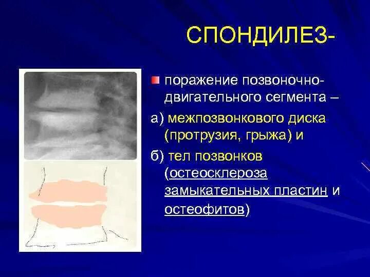 Склероз замыкательных пластинок позвоночника. Остеосклероз замыкательных пластинок. Остеосклероз замыкательных пластин тел позвонков. Остеосклероз тел позвонков кт. Спондилез.