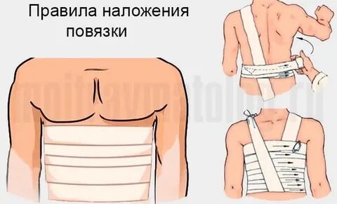 Повязка при переломе ребер