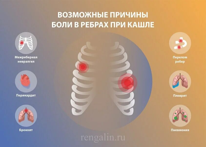 Боли в ребрах легкие. Болит под ребрами при кашле.