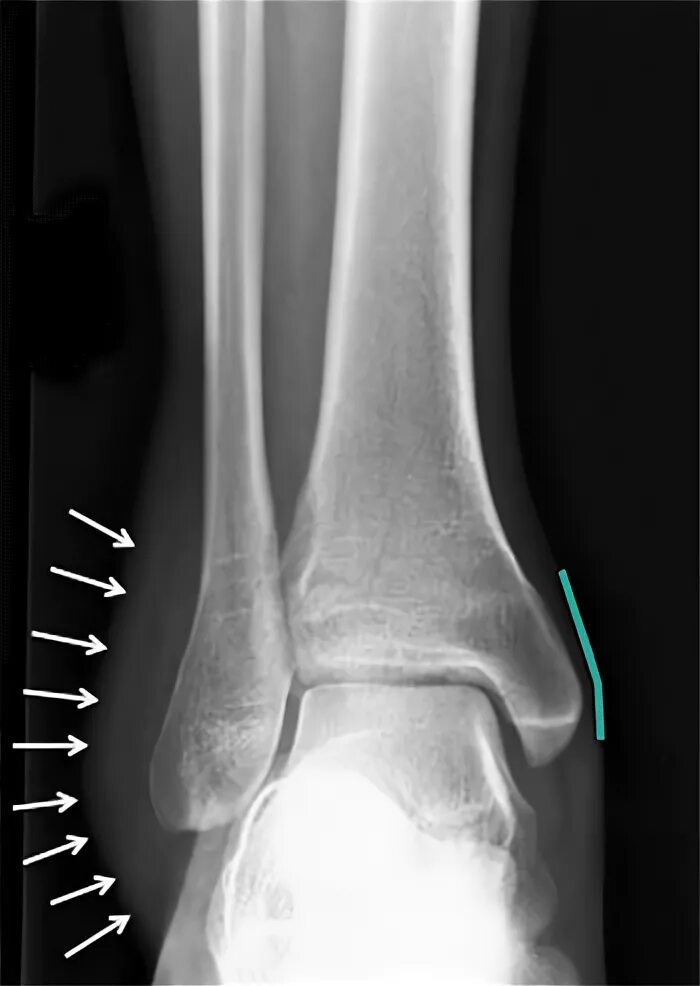 Разрыв связок голеностопного сустава рентген. Разрыв связок голеностопа рентген. Подвывих голеностопа рентген. Вывих голеностопного сустава РЕН. Трещина связке