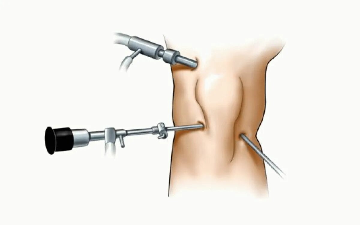 Лапароскопия показания. Операция артроскопия коленного. Артроскопия коленного сустава разрыв мениска. Артроскопическая операция коленного сустава. Операция артроскопия коленного сустава.