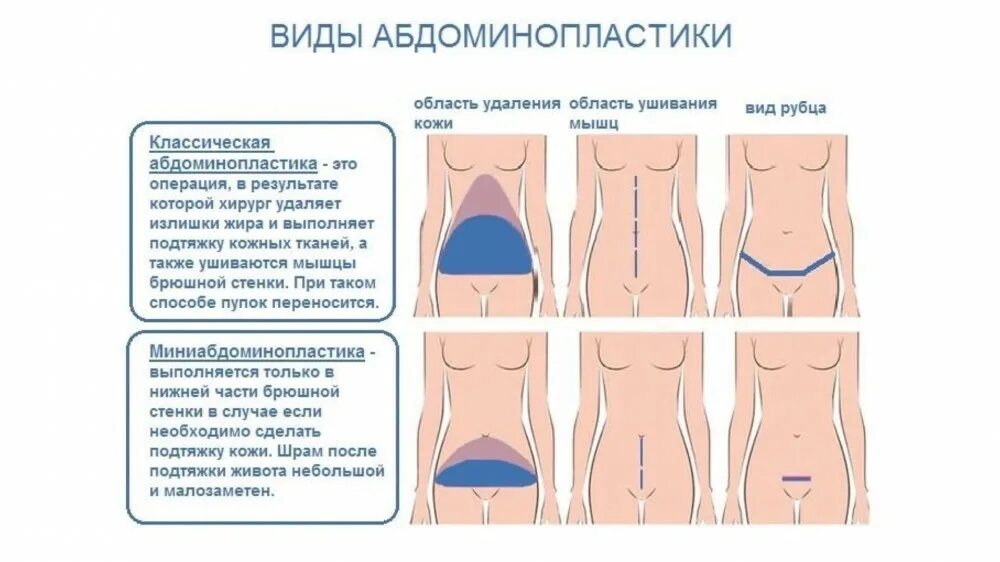 Стоит живот что делать. Операция абдоминопластика живота после операции. пластика живота (абдоминопластика) (2 схема). миниабдоминопластика схема операции. миниабдоминопластика живота схема.