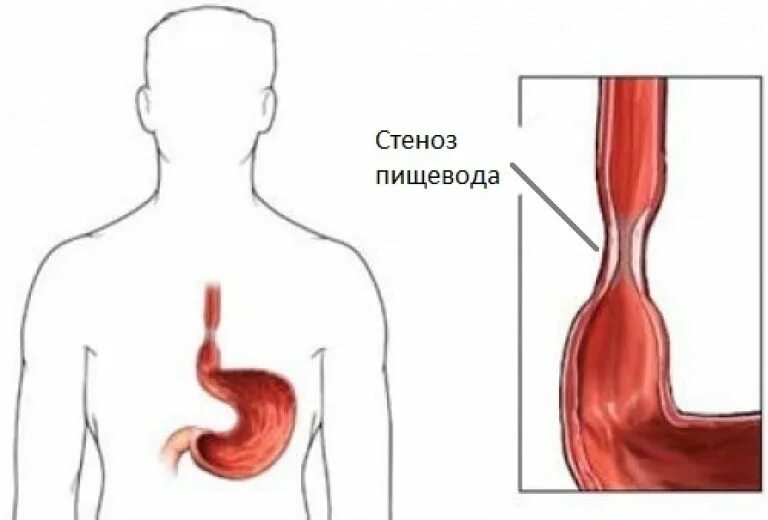 Рубцовые сужения пищевода