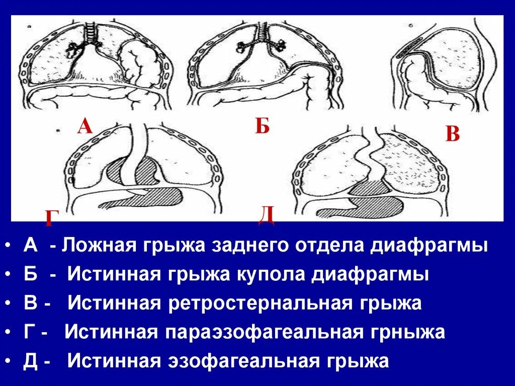 Как лечить диафрагму грыжу