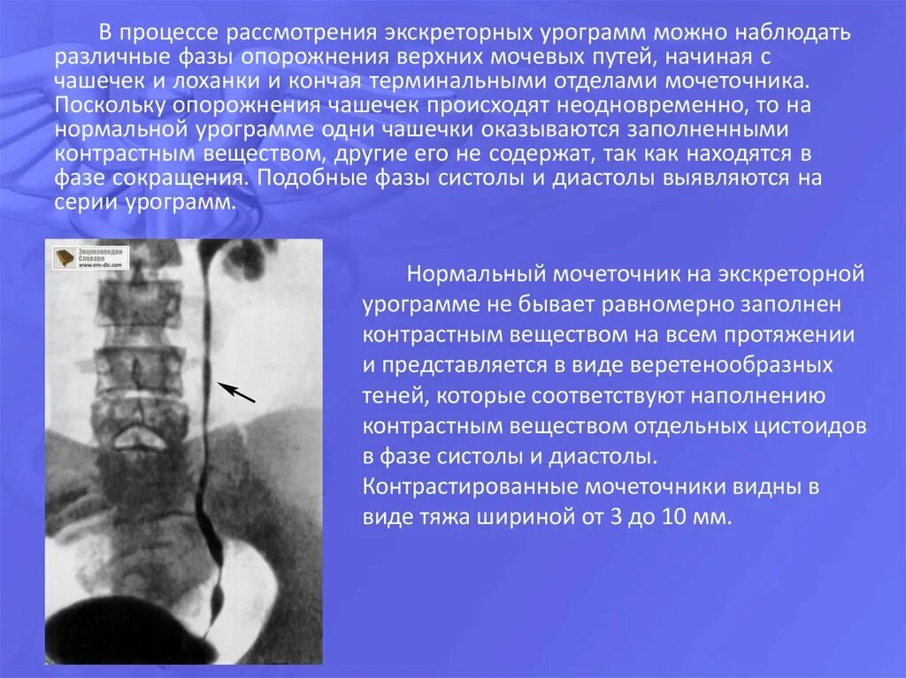 Анализ мочеточника. Терминальный отдел мочеточника. Дефект наполнения мочеточника. Стриктура мочеточника экскреторная урограмма.