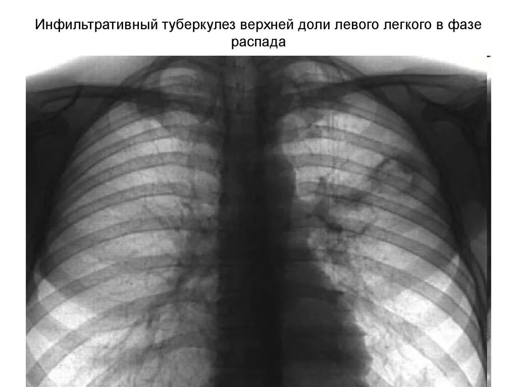 Старый туберкулез. Инфильтративный туберкулез в фазе инфильтрации. Диссеминированный инфильтративный туберкулез. Инфильтративный туберкулез верхней доли. Инфильтративный туберкулез легкого.