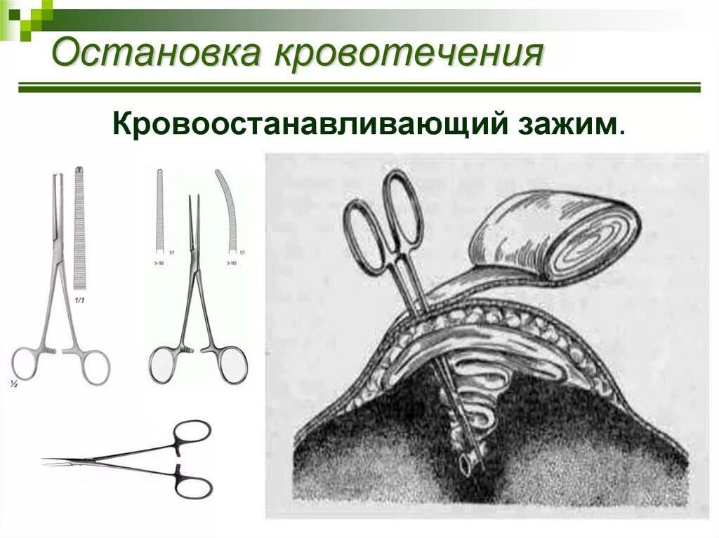 Тампонада раны при кровотечении. Наложение зажима на кровоточащий сосуд. Наложение кровоостанавливающего зажима. Остановка кровотечения наложением зажима. Наложение кровоостанавливающего зажима на сосуд.