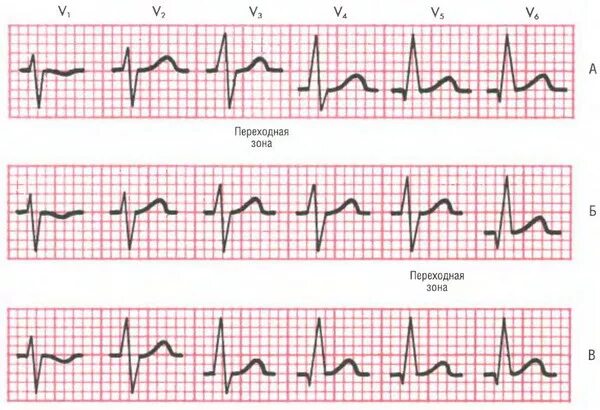 ЭКГ 1 отведение норма. Норма ЭКГ В отведениях v1 v2. Грудные отведения ЭКГ норма. Отведение v1 на экг