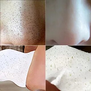 Черные точки лучшее средство