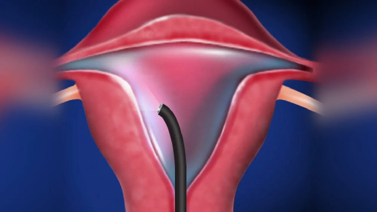 Синехии полости матки гистероскопия. Гистероскопия полипа матки. Гистерорезектоскопия полипа. Удаление матки гинеколог