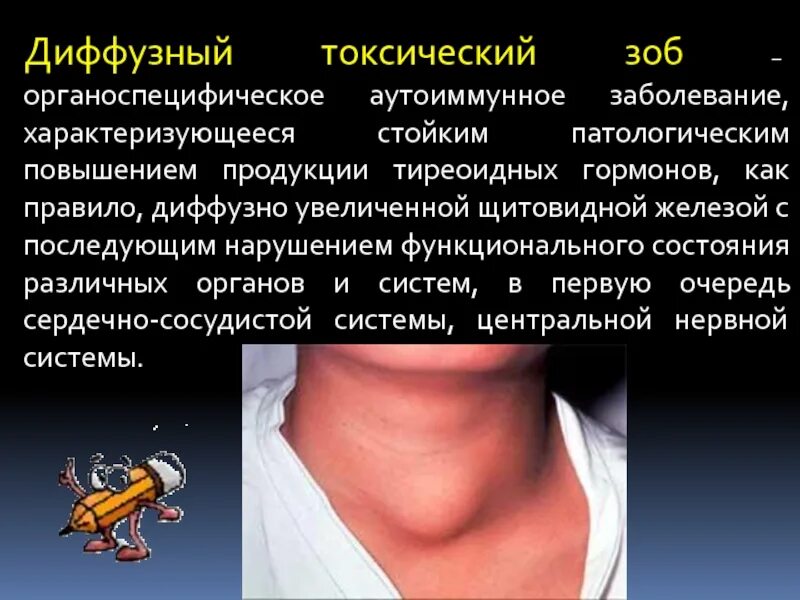 Узи щитовидной железы заключение узловой зоб. Аутоиммунный тиреоидит зоб. Аутоиммунный тиреоидит показатели. Клинические проявления тиреоидит хашимото. Хронический аутоиммунный тиреоидит.