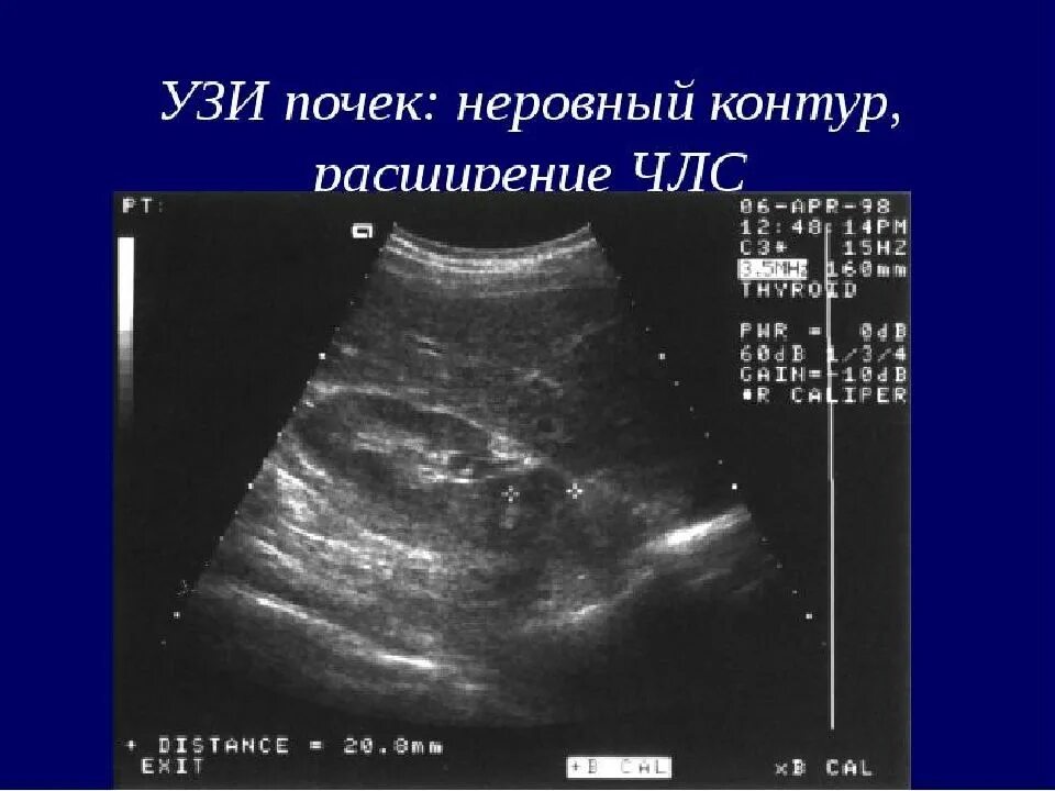 Расширенная члс. Хронический пиелонефрит УЗИ. Расширение ЧЛС почек на УЗИ. УЗИ почек хронический пиелонефрит. УЗИ картина хронического пиелонефрита.