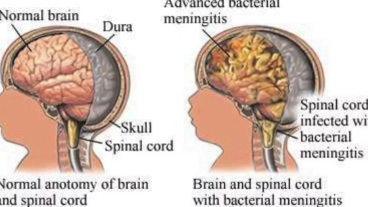 Менингит энцефалит и менингоэнцефалит. Менингоэнцефалит, воспаление головного мозга. Менингит мозговой бактериальный. Бактериальный менингоэнцефалит головного мозга у детей. Поражение оболочек мозга