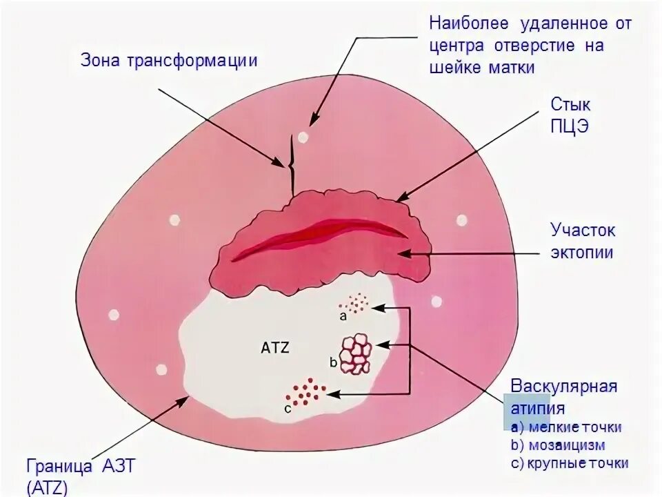 Зона трансформации 3 типа что это