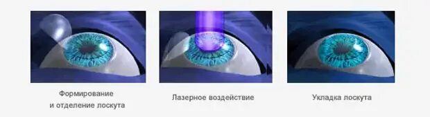 Сколько восстанавливается зрение после лазерной. Лазерная операция на глаза при миопии. Лазерная коррекция зрения при миопии. После лазерной коррекции зрения. Лазерная коррекция зрения астигматизм.