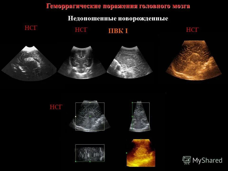 УЗИ анатомия НСГ. УЗИ нейросонография новорожденных. Нейросонография нормы таблица. УЗИ головного мозга нейросонография.