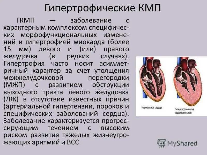 Гипертрофия левого желудочка как лечить. Гипертрофия миокарда левого желудочка. гипертрофической кардиомиопатии. апикальная гипертрофическая кардиомиопатия. изменения при гипертрофии левого желудочка.