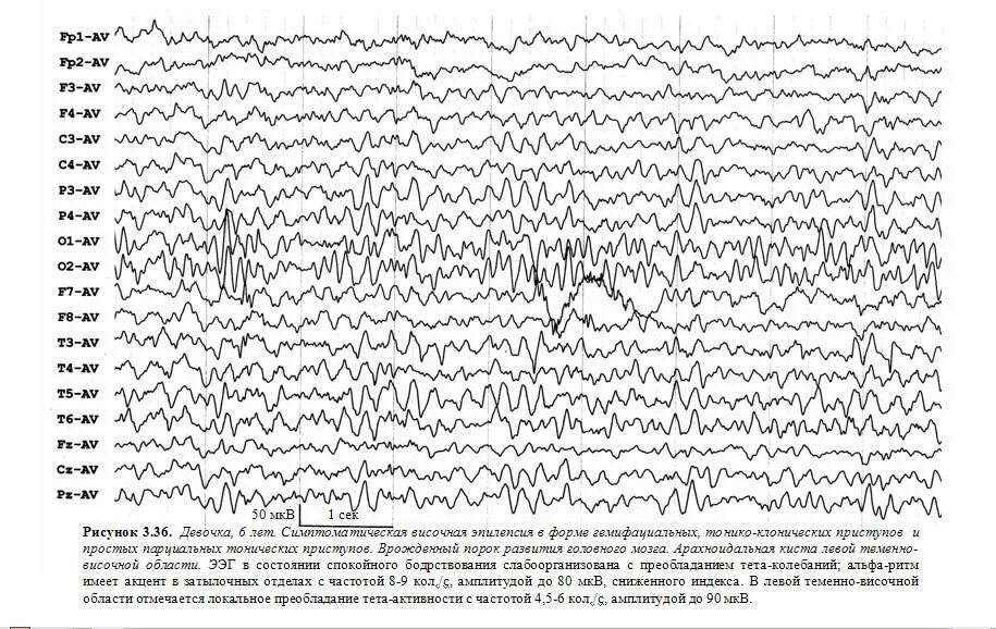 Схема наложения электродов ЭЭГ. 19 Каналов ЭЭГ схема. Иктальный паттерн на ЭЭГ при эпилепсии. Схема отведений ЭЭГ.