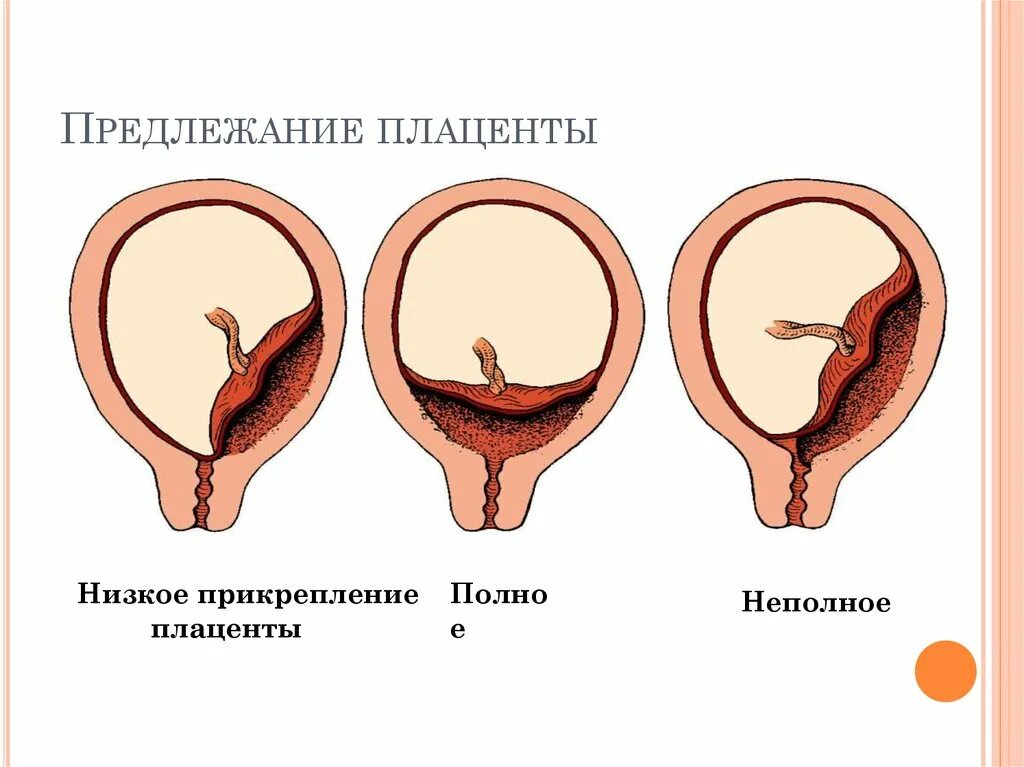 При низкой плацентации можно. Полное и частичное предлежание плаценты. Неполное предлежание плаценты. Переднее прикрепление краевое предлежание плаценты. Предлежание плаценты при беременности.