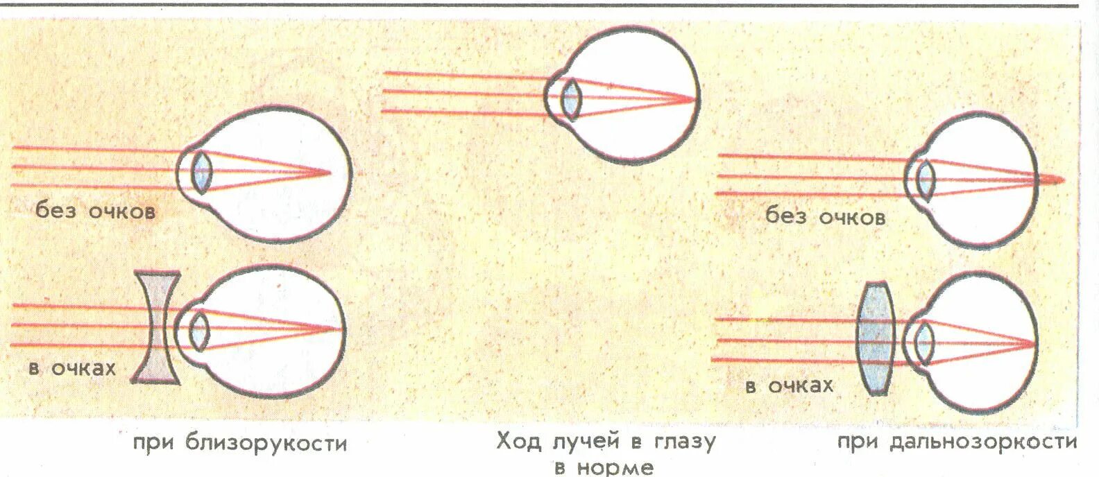 Глаз очки дальнозоркость и близорукость. Дальнозоркость и близорукость строение глаза. Близорукость и дальнозоркость схема глаза. Очки ( схемы : близорукость и дальнозоркость). Оптическая схема коррекции близорукости/дальнозоркости.