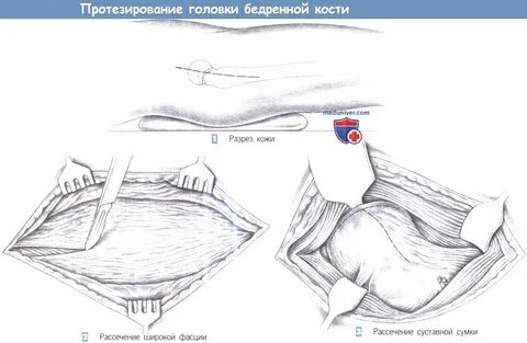 Разрез бедра