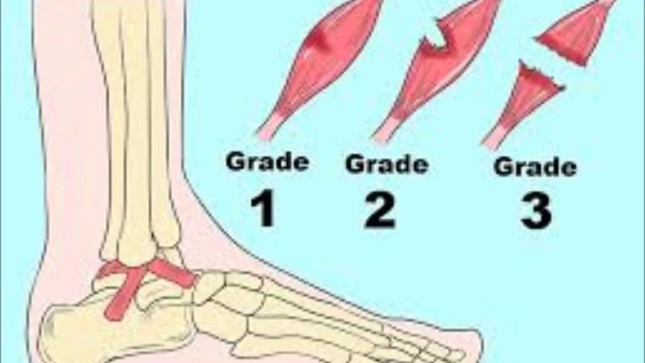 Растяжение 3 степени лодыжки. Растяжение связок 2 степени. Растяжение голеностопа 1 степени. 3 Степень растяжения голеностопа.