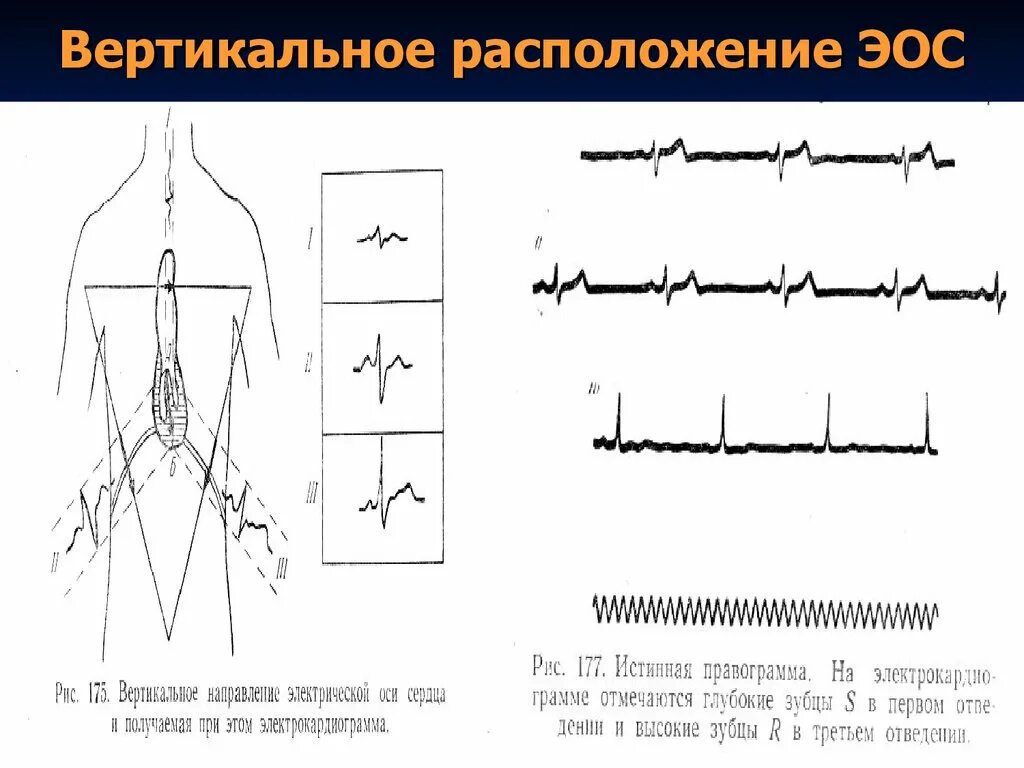 Вертикальная позиция сердца. Электрическая ось сердца отклонена вертикально. Вертикальное и горизонтальное положение ЭОС. Вертикальная электрическая ось сердца у ребенка. Вертикальная ось на ЭКГ.