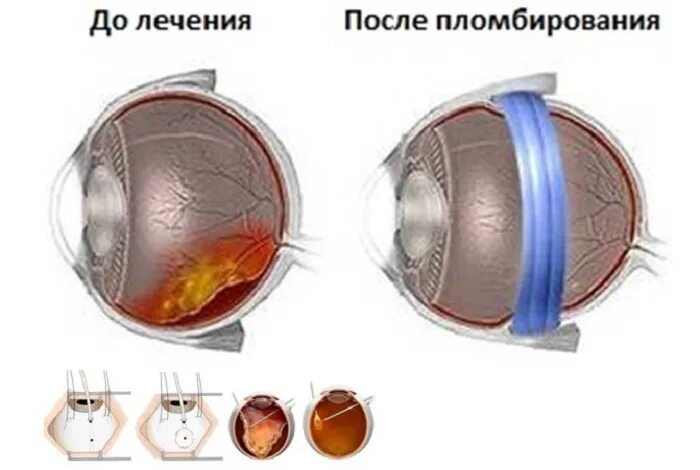 Отслойка сетчатки экстрасклеральное пломбирование. Склеральное пломбирование сетчатки. Экстрасклеральное пломбирование при отслойке сетчатки. Экстрасклеральное пломбирование сетчатки глаза. Стекловидное тело операция