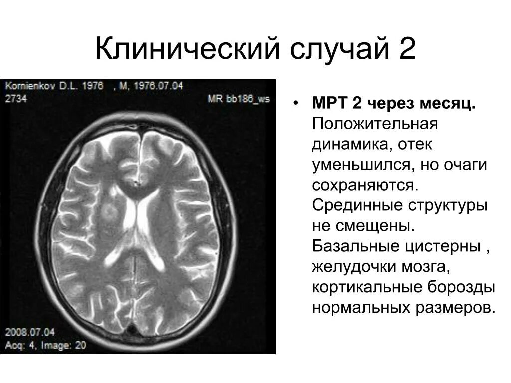 Дилатация бокового желудочка мозга. Желудочки головного мозга норма кт. Боковые желудочки головного мозга на мрт. Мрт желудочков головного мозга в норме. Расширение боковых желудочков.