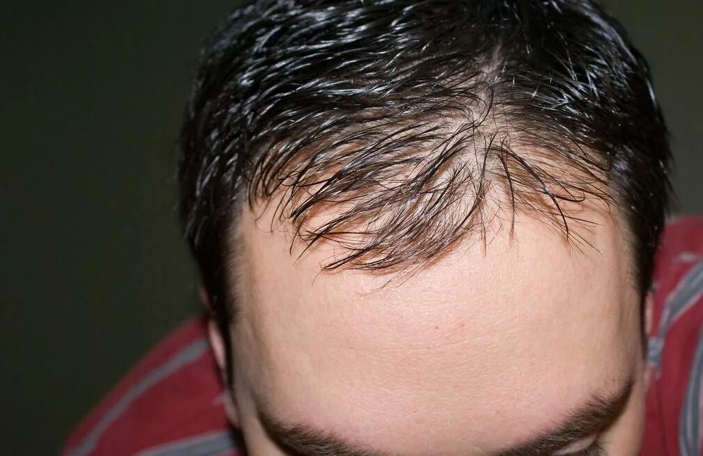 Причину выпадения волос после 40. Сальные волосы у мужчин. Сальные грязные волосы у мужчин. Жирные волосы у мужчин.