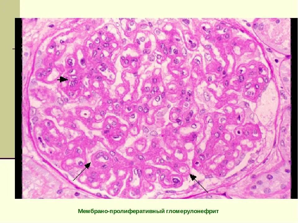 Интракапиллярный гломерулонефрит макропрепарат. Эндокапиллярный гломерулонефрит. Подострый гломерулонефрит макропрепарат. Интракапиллярный пролиферативный гломерулонефрит микропрепарат. Хронический диффузный гломерулонефрит